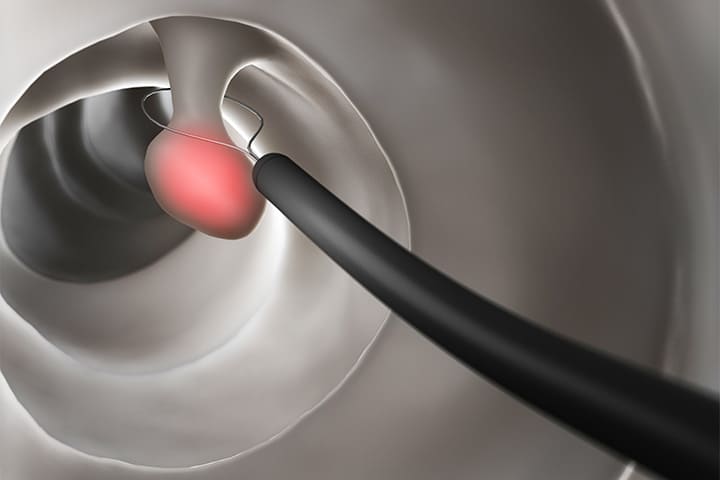 大腸ポリープ切除